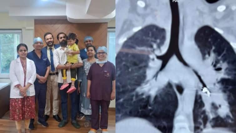 चिमुकल्याचा खोकला तीन महिने थांबेना, सर्व उपचार केले, तीन महिन्यांनी कळलं LED बल्ब गिळला, यशस्वी शस्त्रक्रिया